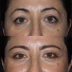 Eye Bag removal