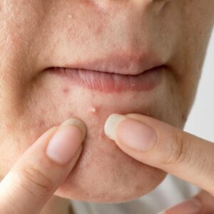 Chemical Peels for Acne What to Expect