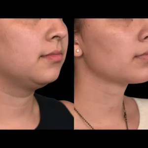 Double chin removal
