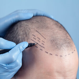 Crown Hair Transplant in Islamabad