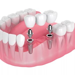 Dental Crowns and Bridges