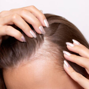 Does Alopecia Areata Treatment Improves Hair Growth?