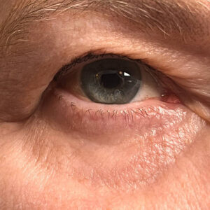 Eyelid Surgery: A Solution for Drooping Eyes