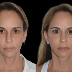 Chin Fillers in Dubai