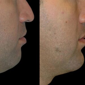 Chin Fillers in Dubai