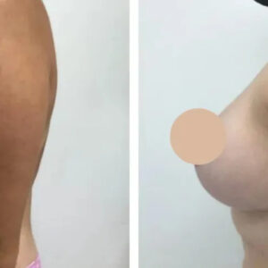 breast reduction in dubai