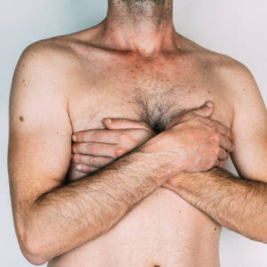 How Fast Can You Heal From Gynecomastia Surgery?