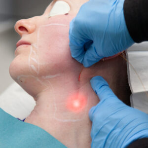 Endolift