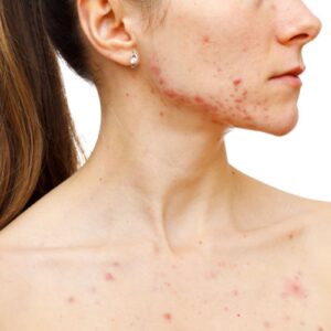 Is Acne Treatment Safe for Pregnant Women?