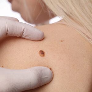 Minimally Invasive Skin Lesion Treatments