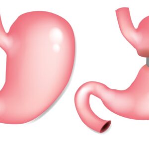 Gastric Balloon Placement