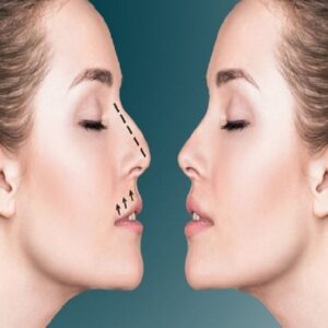 عملية تجميل الأنف في الرياض
