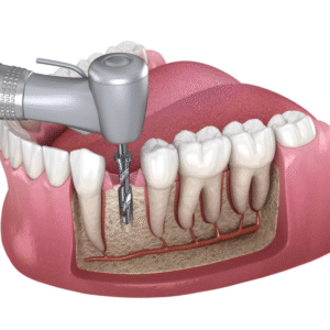 Root Canal Treatment in Dubai