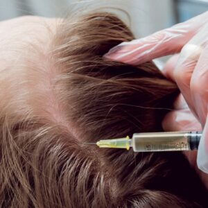 The Future of Hair Regrowth PRP Hair Treatment