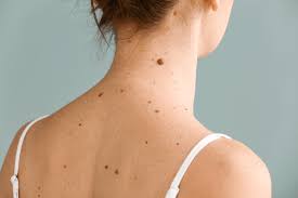 What Is the Best Treatment for Skin Tag Removal?