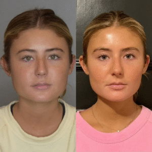 Buccal fat removal