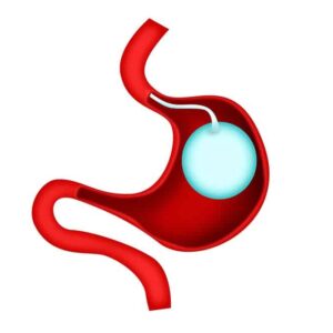 Gastric Balloon Placement