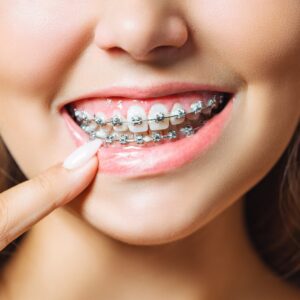 Teeth Braces Costs in Dubai