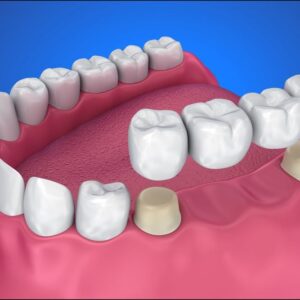 Dental Crowns and Bridges