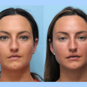 The Art of Beauty at the Best Aesthetic Clinic in Dubai for Thread Lift