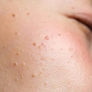 Skin Wart Removal