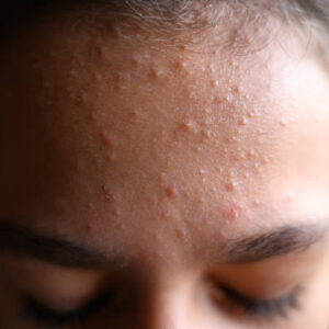 Does Acne Treatment Help Remove Old Scars