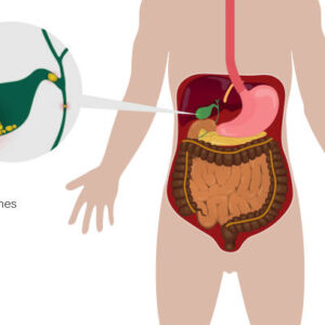 gallstones singapore