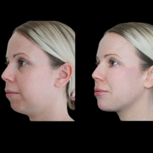 Jawline Fillers