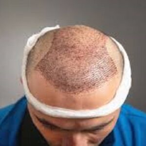 زراعة الشعر في الرياض