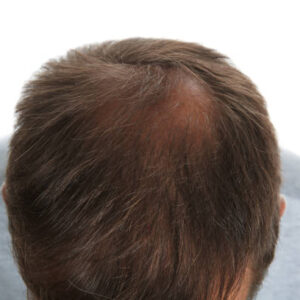 How to Care for Hair After Crown Transplant