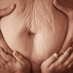 How to Maintain Results After Tummy Tuck Surgery?