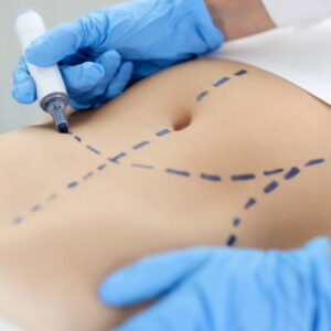 Mini Abdominoplasty Surgery: Real Results Revealed