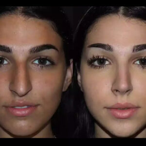 Septoplasty in Dubai