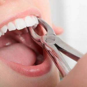 Tooth Extractions in Winslow, AZ