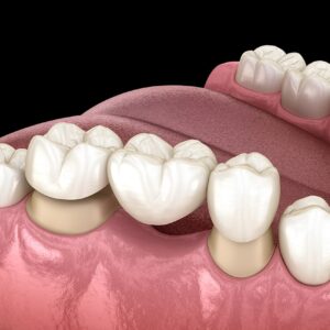 Dental Crowns and Bridges