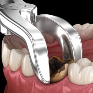 Tooth Extraction