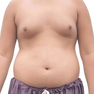 Gynecomastia Treatment