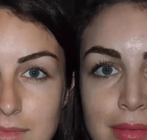 best septoplasty surgeon in dubai