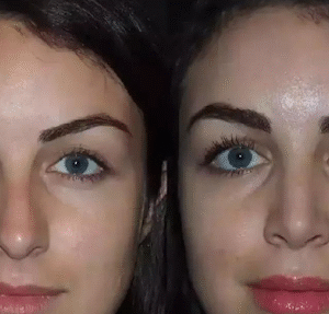 best rhinoplasty surgeon in dubai