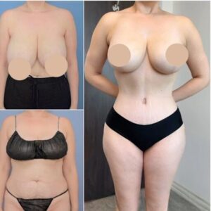 tummy tuck in Dubai
