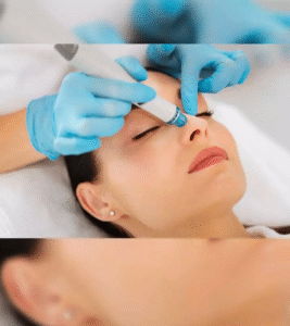 Achieve Clear Skin Fast with Laser Acne Scar Treatment