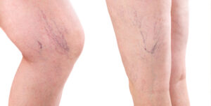 Achieve Healthy Legs with Sclerotherapy