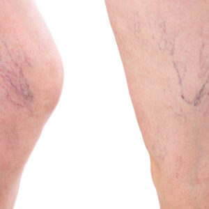 Achieve Healthy Legs with Sclerotherapy