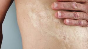 Burn Reconstructive Surgery The Gold Standard in Recovery