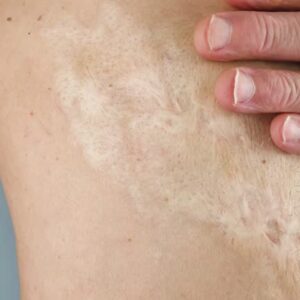 Burn Reconstructive Surgery The Gold Standard in Recovery