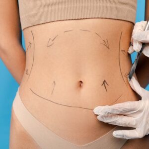 Fat removal surgery in Riyadh