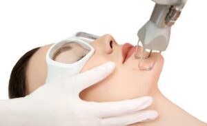 Fractional CO2 Laser Therapy for Sun Damage
