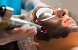 Laser Carbon Peel for Acne Scar Reduction