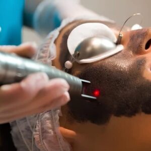 Laser Carbon Peel for Acne Scar Reduction
