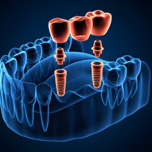 Maximize Your Investment Dental Crown Care Tips for Longevity in Irving, TX